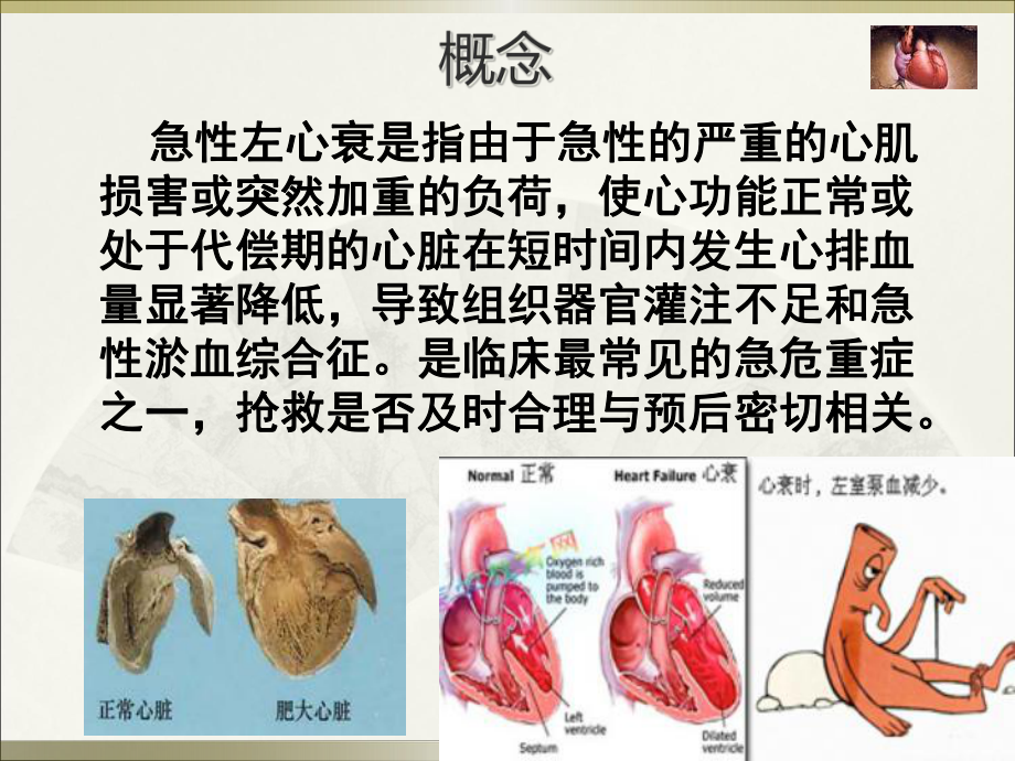 急性左心衰的急救护理1教材课件.ppt_第2页