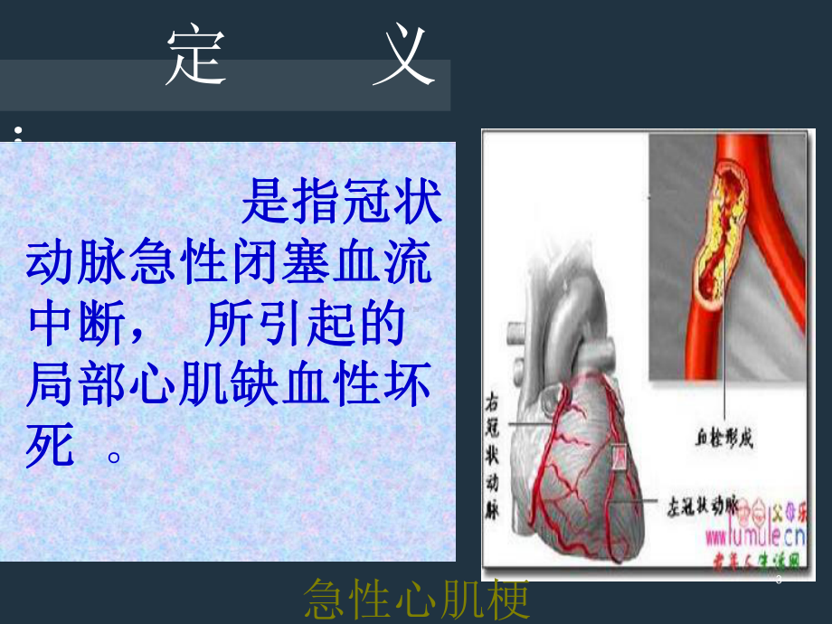 急性心肌梗死抢救护理培训课件.ppt_第3页