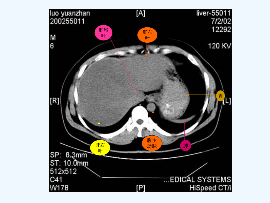 普外科必看腹部CT课件.ppt_第3页