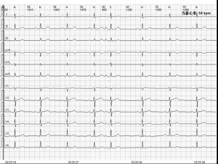 常见心电图的分析和诊疗培训课件.ppt_第2页