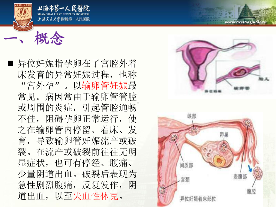 异位妊娠腹腔大出血的抢救配合教材课件.ppt_第2页