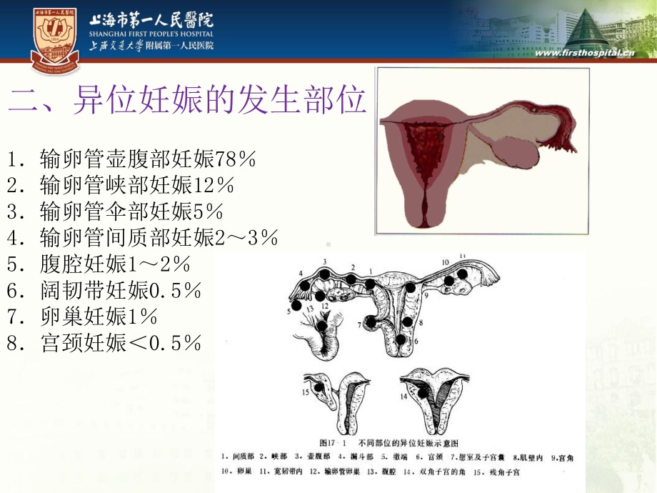 异位妊娠腹腔大出血的抢救配合教材课件.ppt_第3页