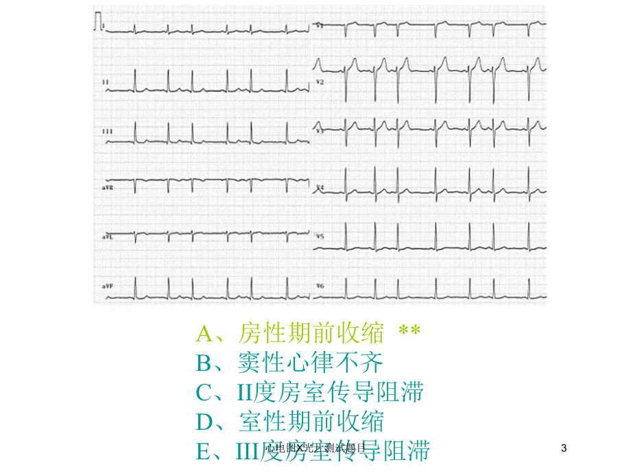 心电图X光片测试题目培训课件.ppt_第3页