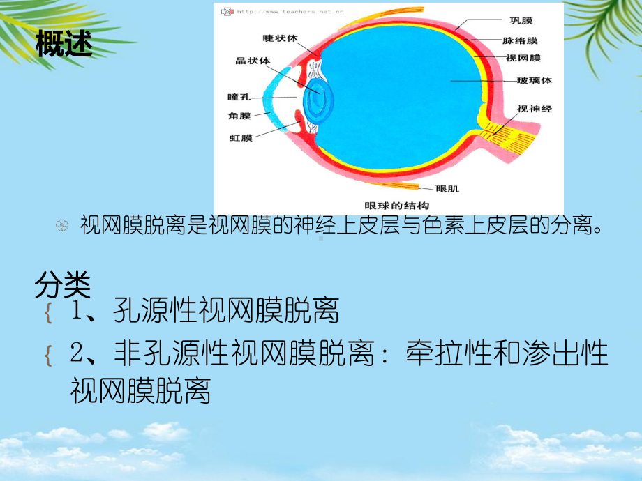 教培用视网膜脱离术后护理课件.ppt_第2页