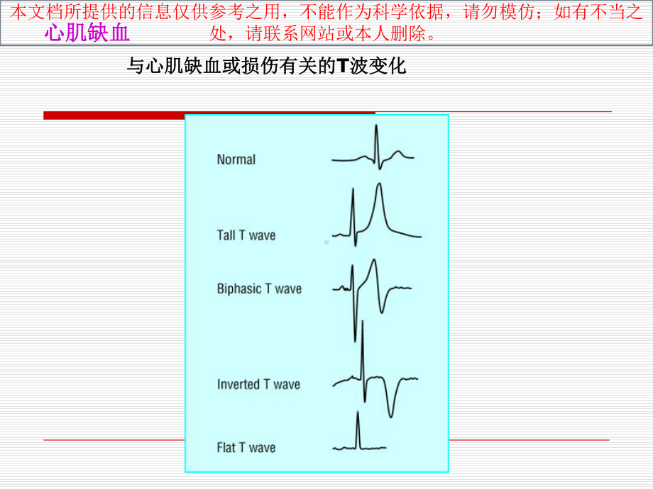 心肌缺血损伤心梗培训课件.ppt_第3页