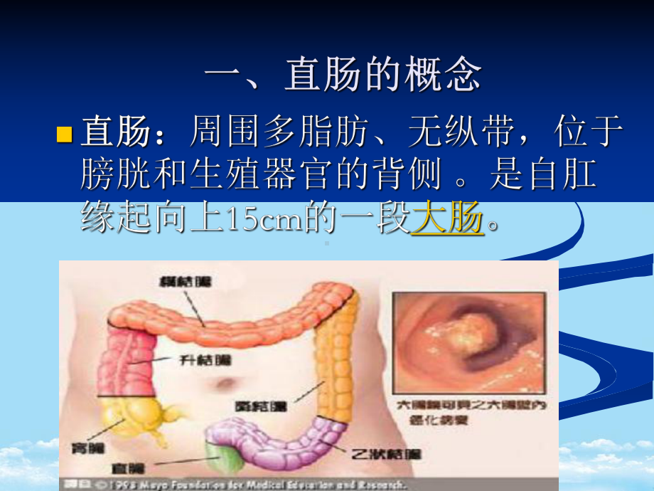 普外手术-手术-步骤-mils手术-麦氏手术-手术配合全面课件.pptx_第3页