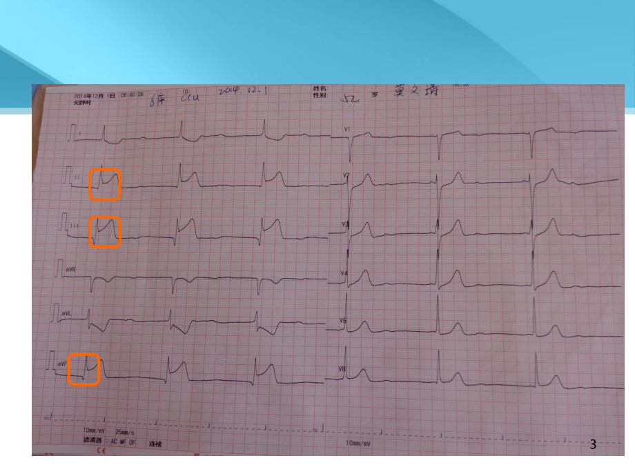 心肌梗死专业医疗知识宣讲培训课件-2.ppt_第3页