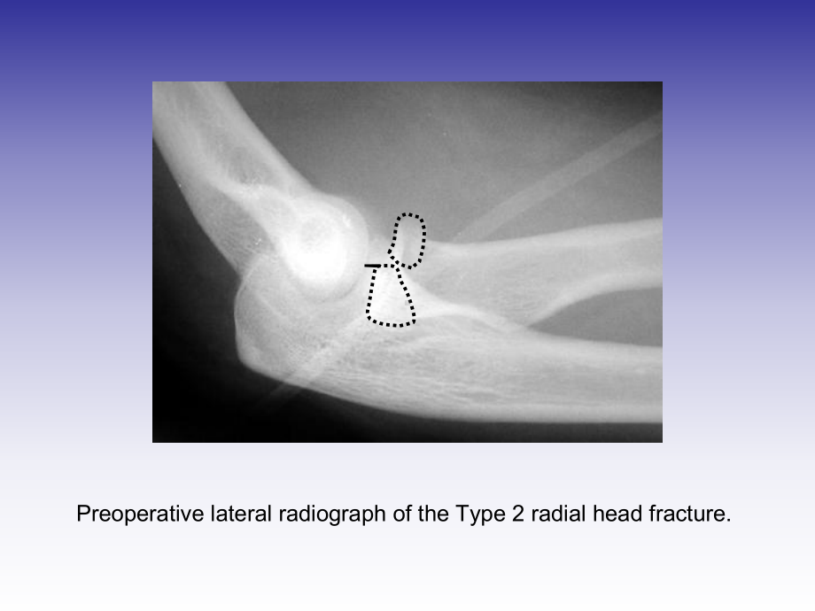 桡骨小头骨折切开内固定术课件.ppt_第3页