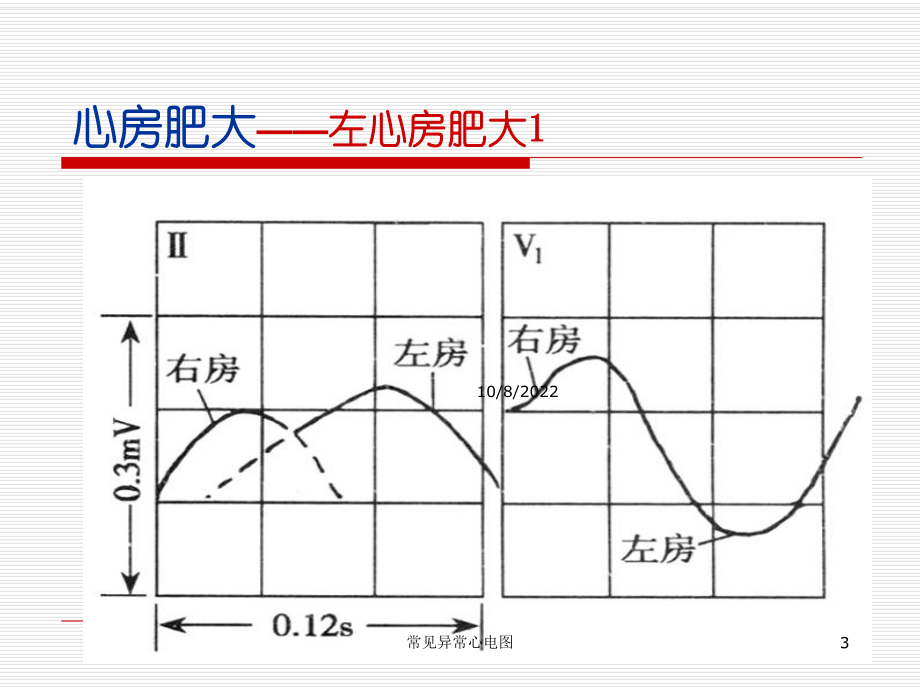 常见异常心电图培训课件.ppt_第3页