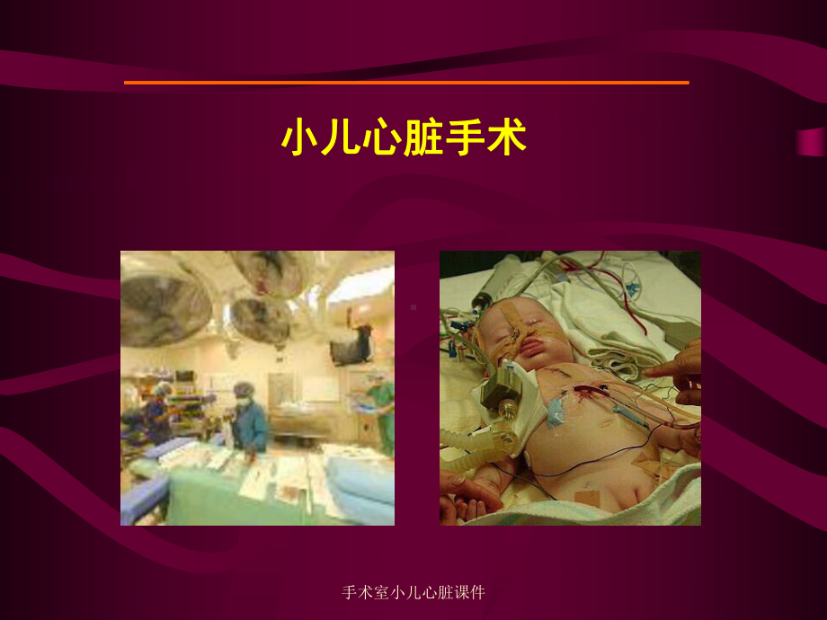 手术室小儿心脏课件.ppt_第1页