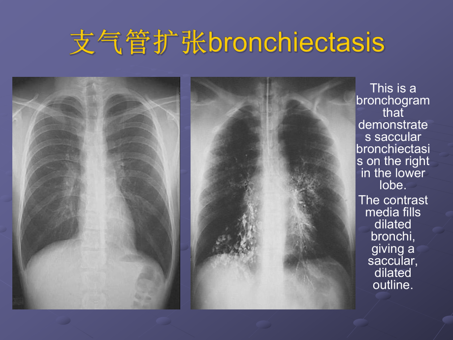 支气管扩张症及咯血护理教材课件.ppt_第3页