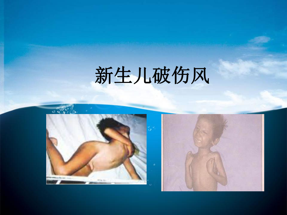 新生儿破伤风素材课件.ppt_第1页