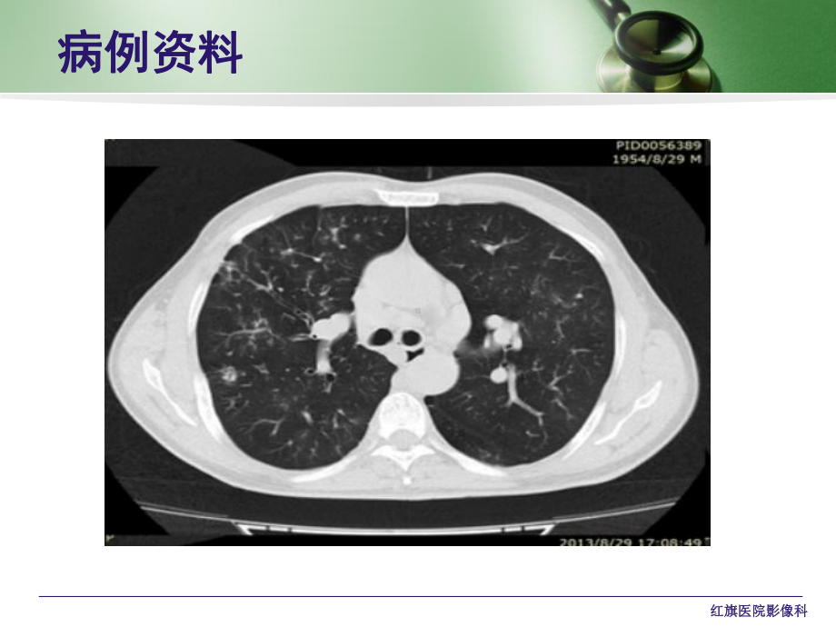 支气管扩张实习讲课视频(附典型征象)课件.ppt_第3页