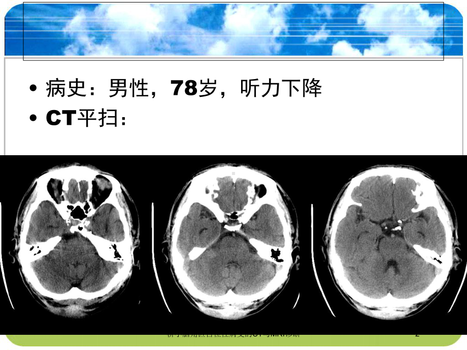 桥小脑角区占位性病变的CT与MRI诊断培训课件.ppt_第2页