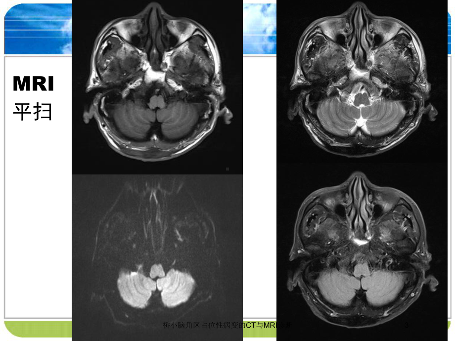 桥小脑角区占位性病变的CT与MRI诊断培训课件.ppt_第3页