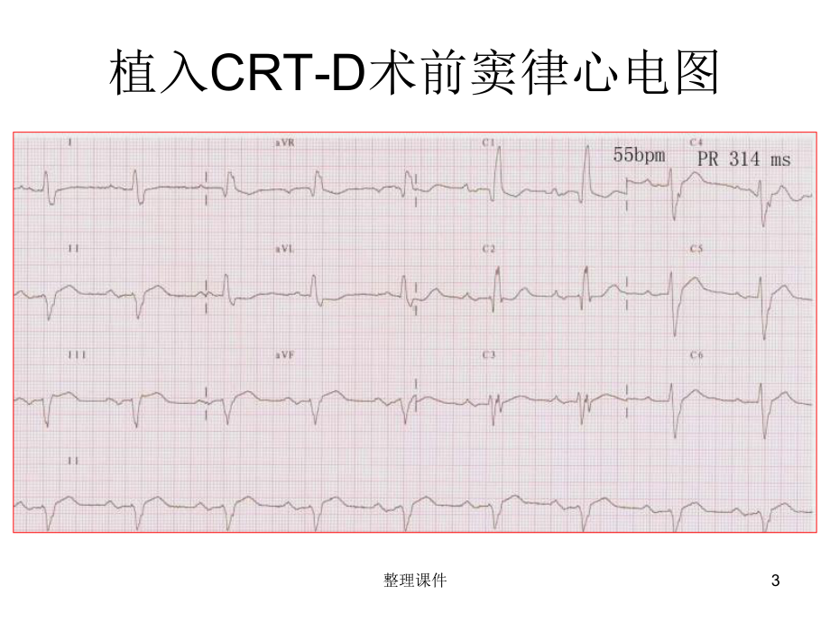 根据起搏器腔内图诊断心动过速课件.ppt_第3页