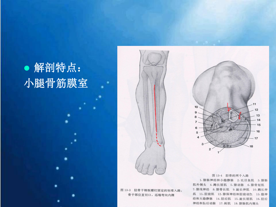 新版胫腓骨骨折课件.pptx_第3页