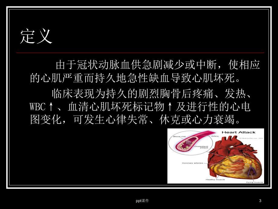 急性ST段抬高型心肌梗死-课件.ppt_第3页