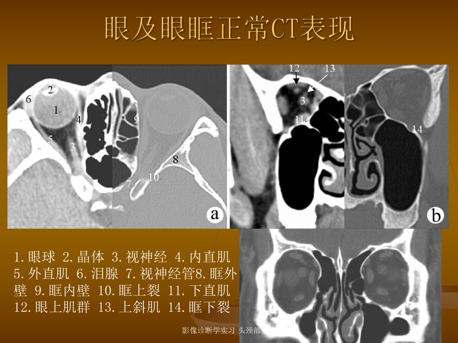 影像诊断学实习-头颈部实习课件.ppt_第3页