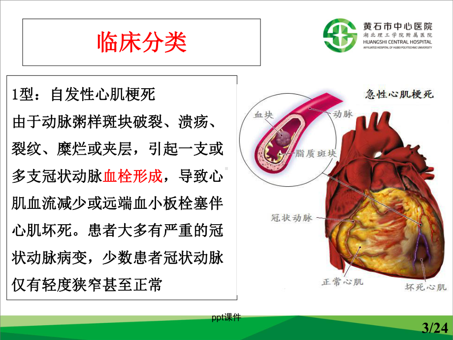 急性心肌梗死与再灌注治疗-课件.ppt_第3页