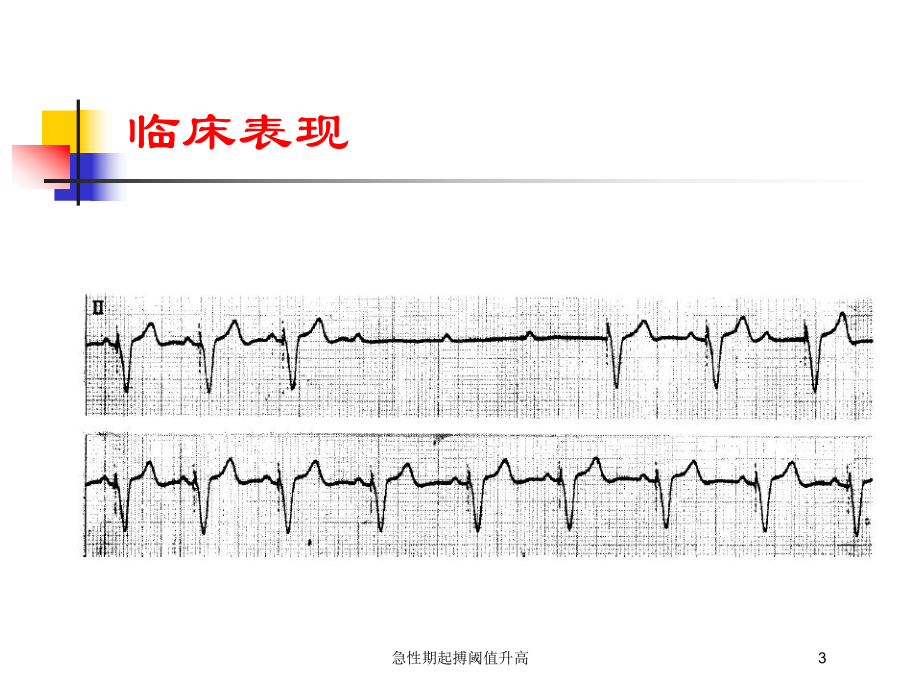 急性期起搏阈值升高培训课件.ppt_第3页