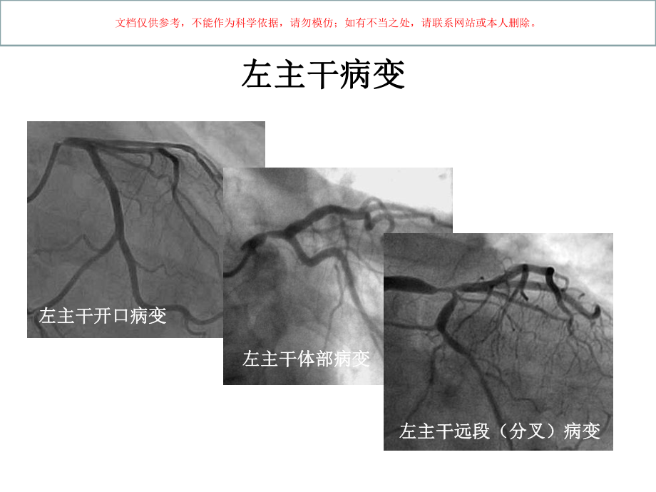 左主干病变介入治疗培训课件.ppt_第3页