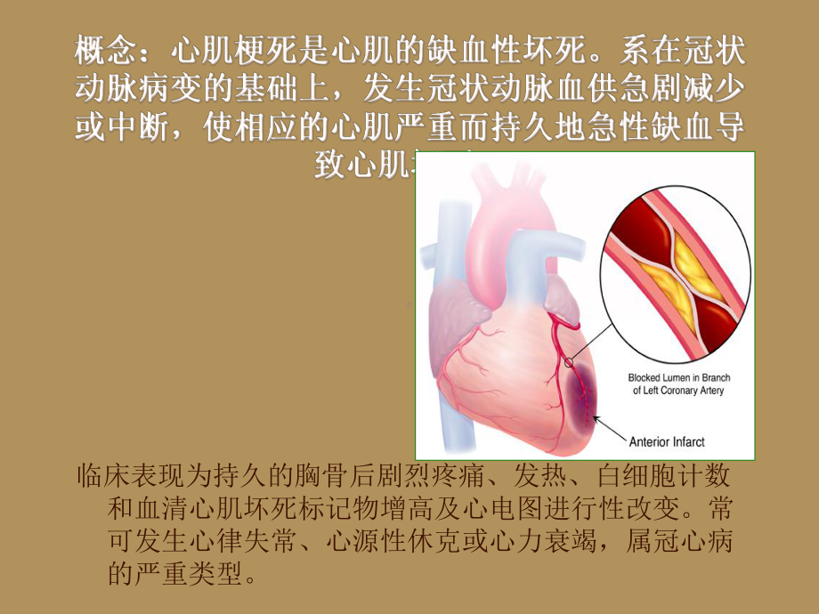 心肌梗死的护理常规课件.ppt_第2页