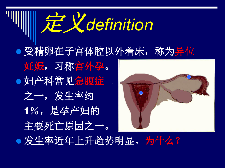 异位妊娠材料张课件.pptx_第3页