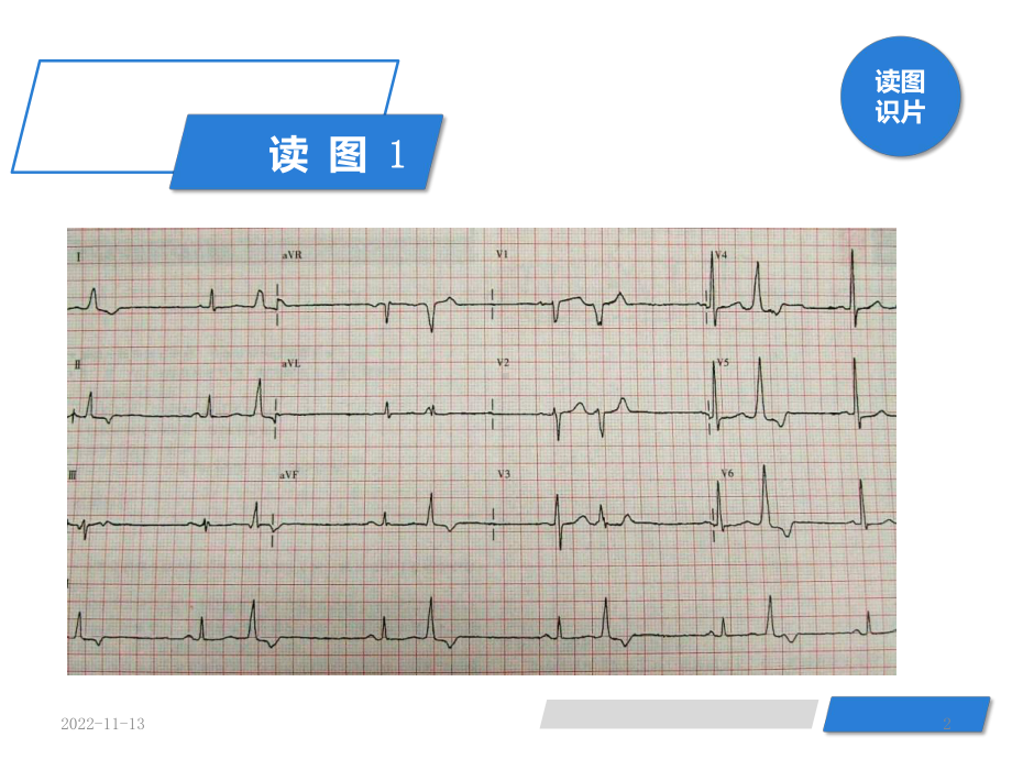 心电图(室性早搏)参考课件.ppt_第2页