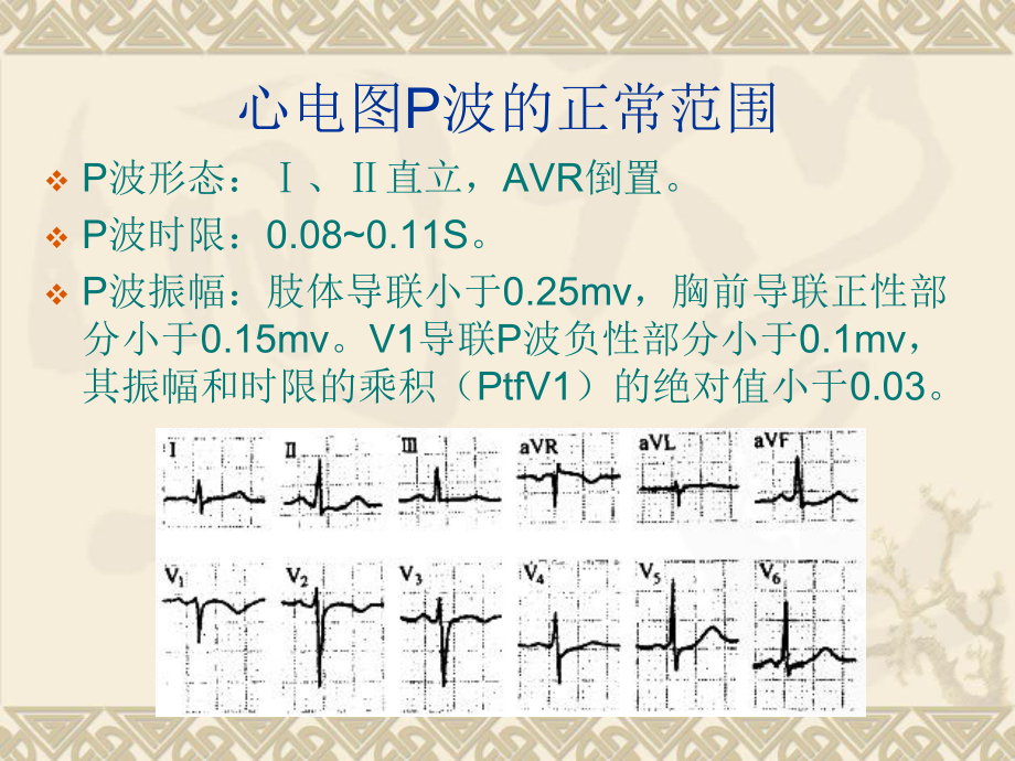 常见心律失常的诊断和处理综述课件.ppt_第3页