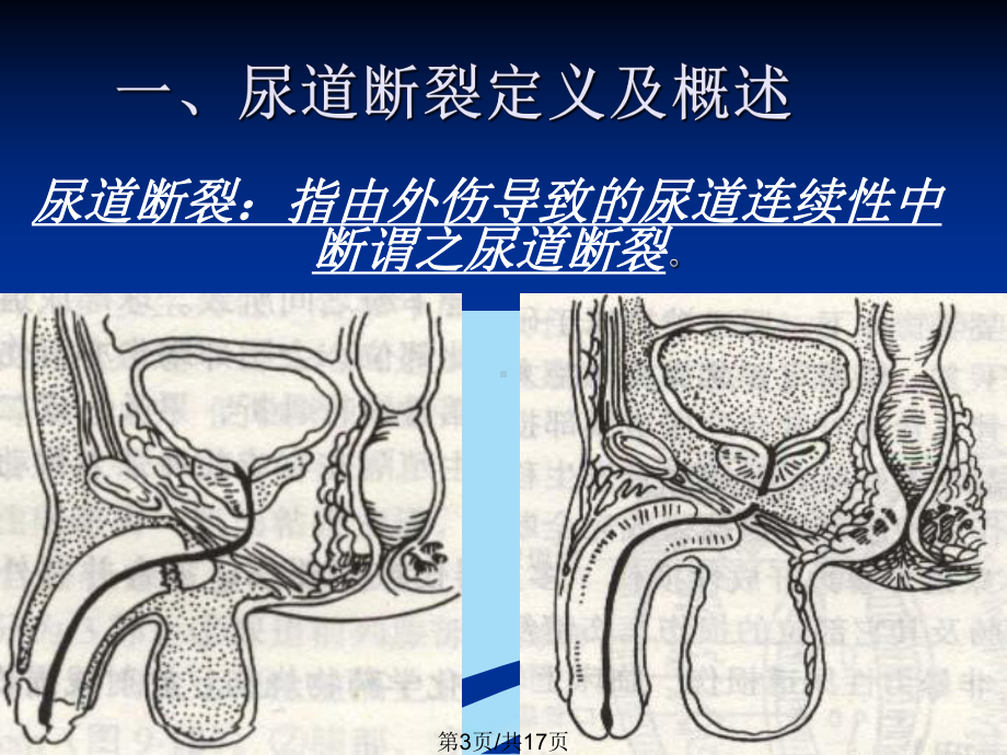 尿道断裂全面版课件.pptx_第3页