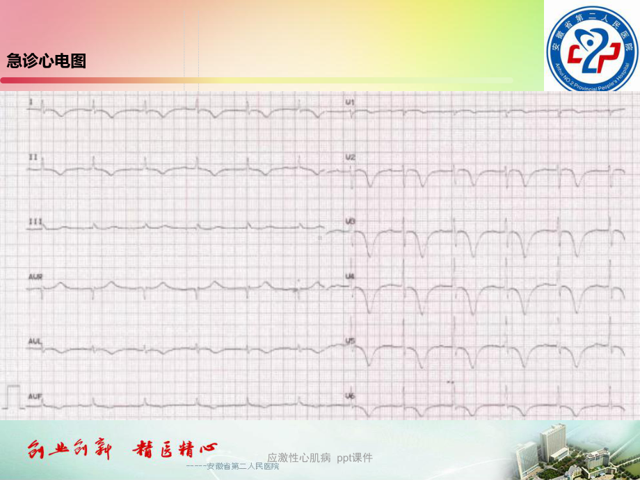 应激性心肌病-课件-2.ppt_第2页