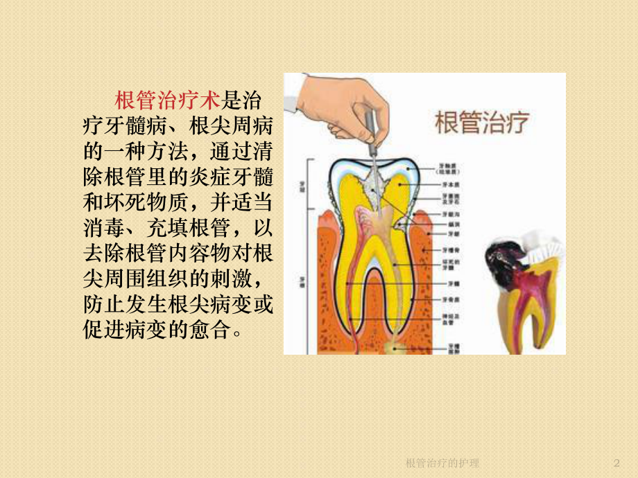 根管治疗的护理培训课件.ppt_第2页