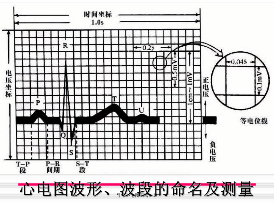 异常心电图图谱汇总培训课件.ppt_第2页