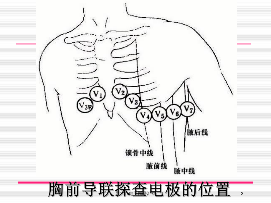 异常心电图图谱汇总培训课件.ppt_第3页