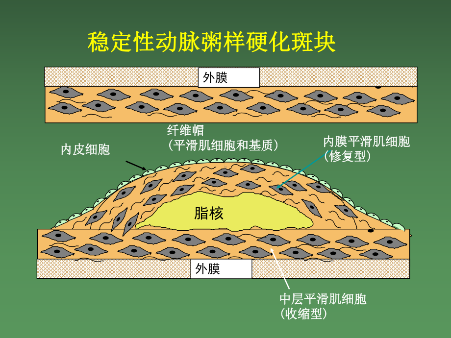 急性冠脉综合征心电图课件.ppt_第2页