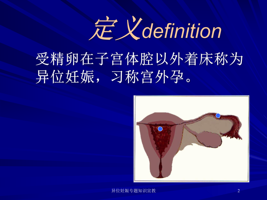 异位妊娠专题知识宣教培训课件.ppt_第2页