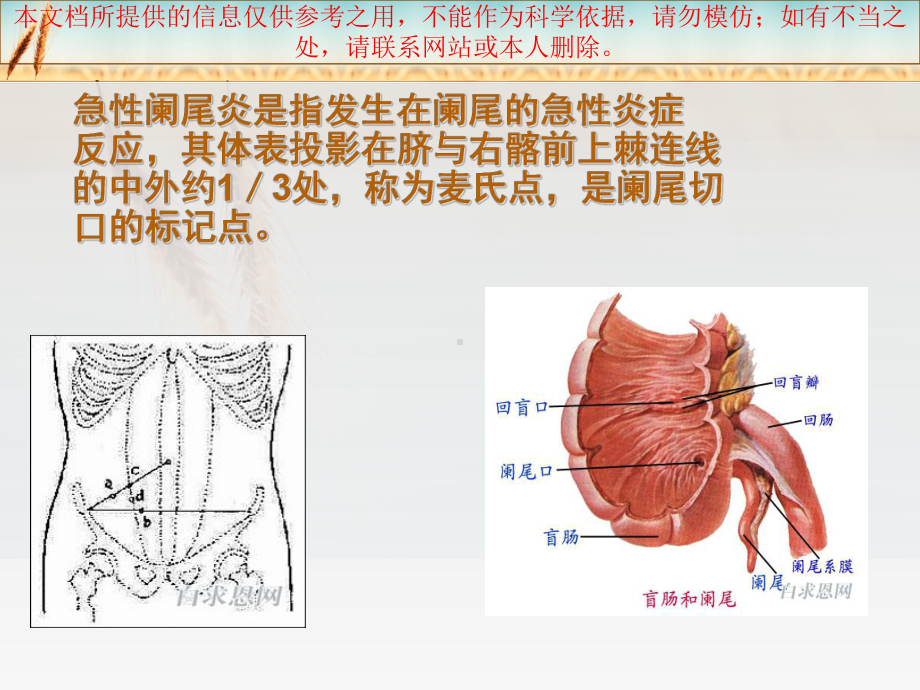 急性阑尾炎的医疗护理培训课件.ppt_第3页