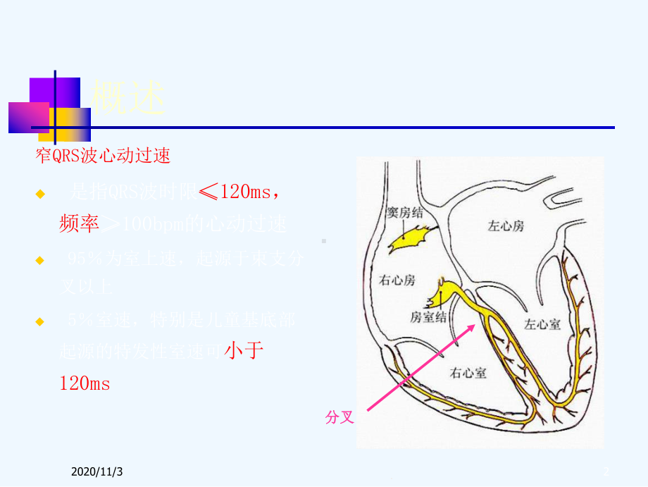 心内窄QRS心动过速鉴别诊断课件.ppt_第2页