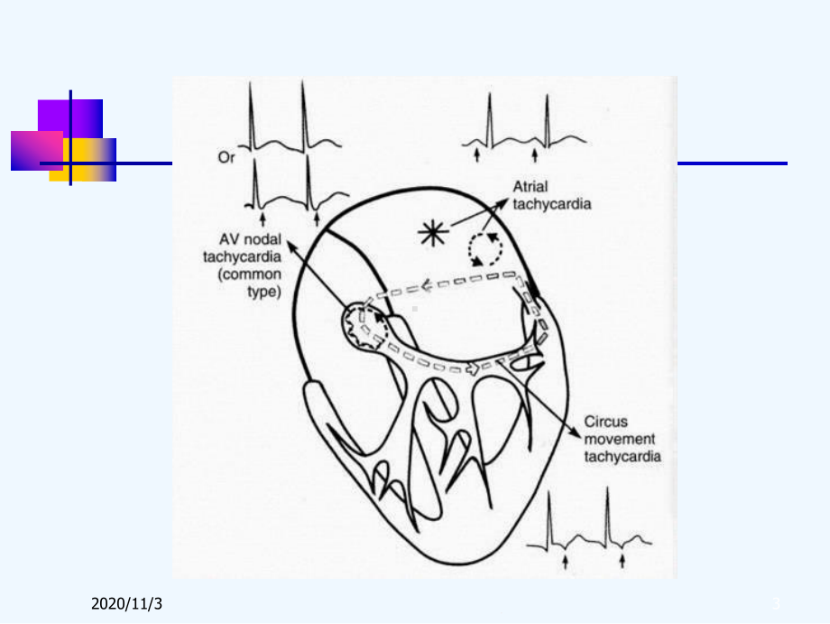 心内窄QRS心动过速鉴别诊断课件.ppt_第3页