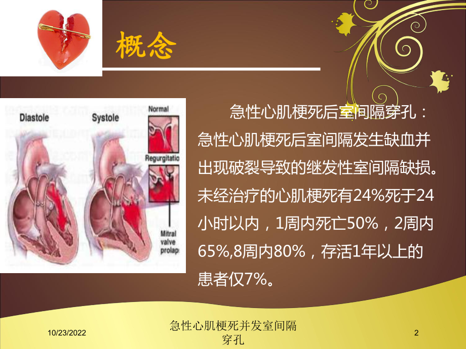 急性心肌梗死并发室间隔穿孔培训课件.ppt_第2页