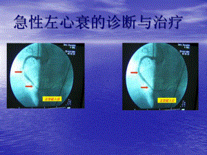 急性左心衰的诊断与治疗教学课件.pptx