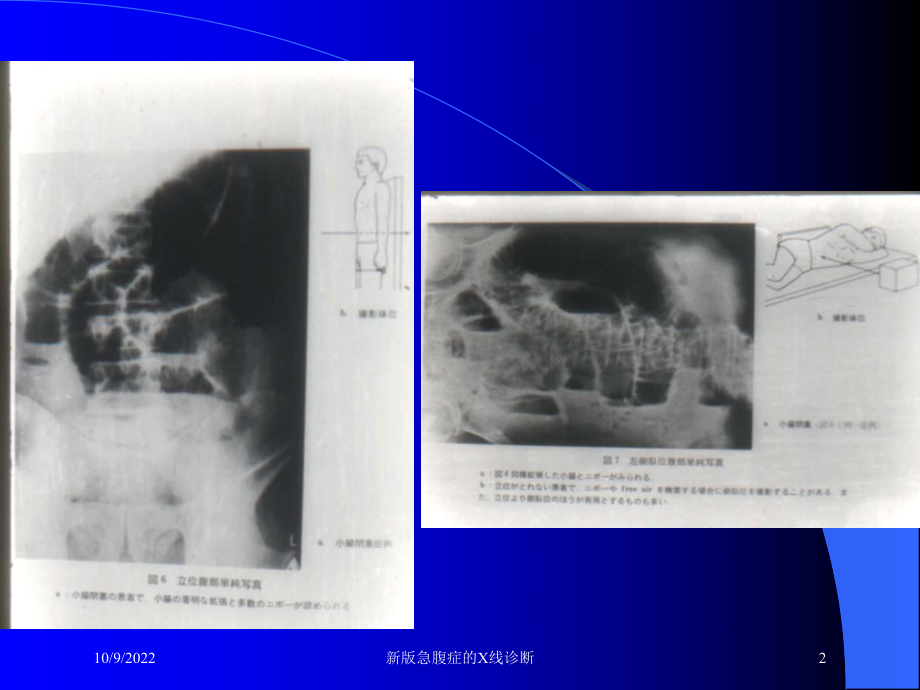 新版急腹症的X线诊断培训课件.ppt_第2页