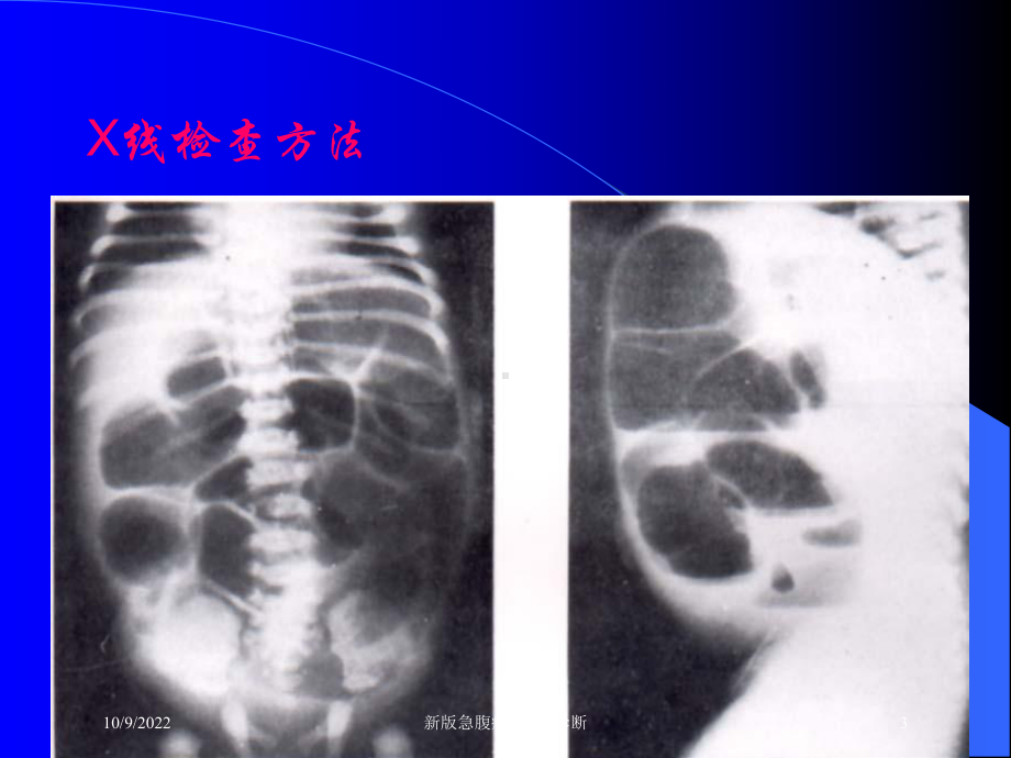 新版急腹症的X线诊断培训课件.ppt_第3页