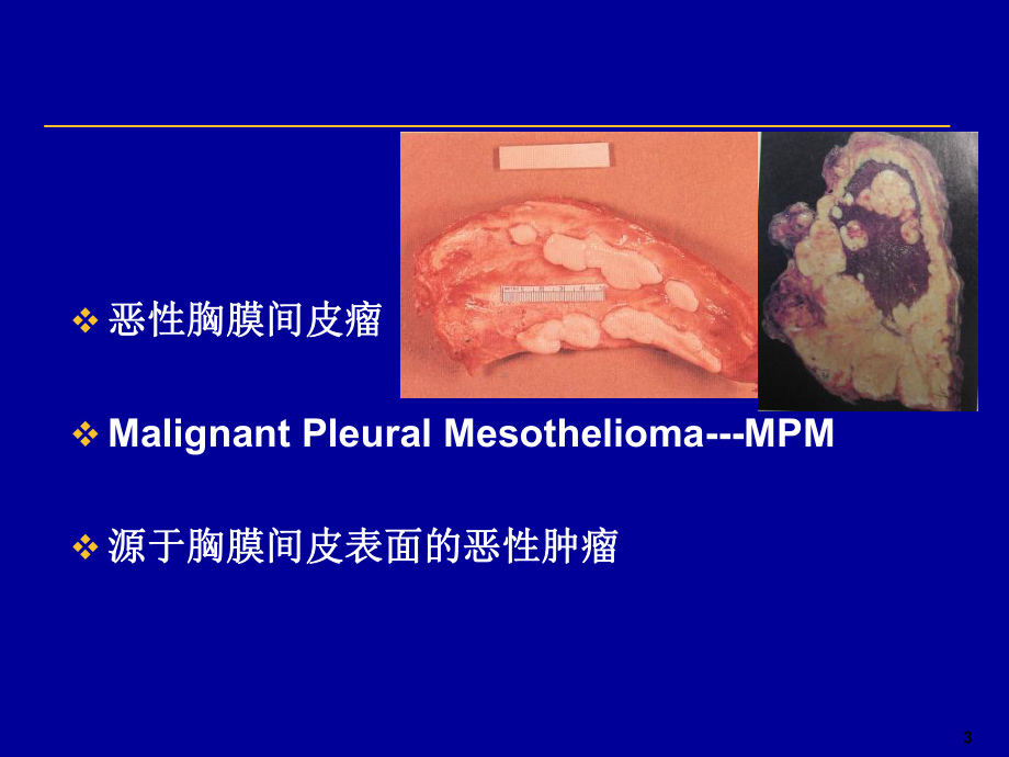 恶性胸膜间皮瘤2课件.ppt_第3页