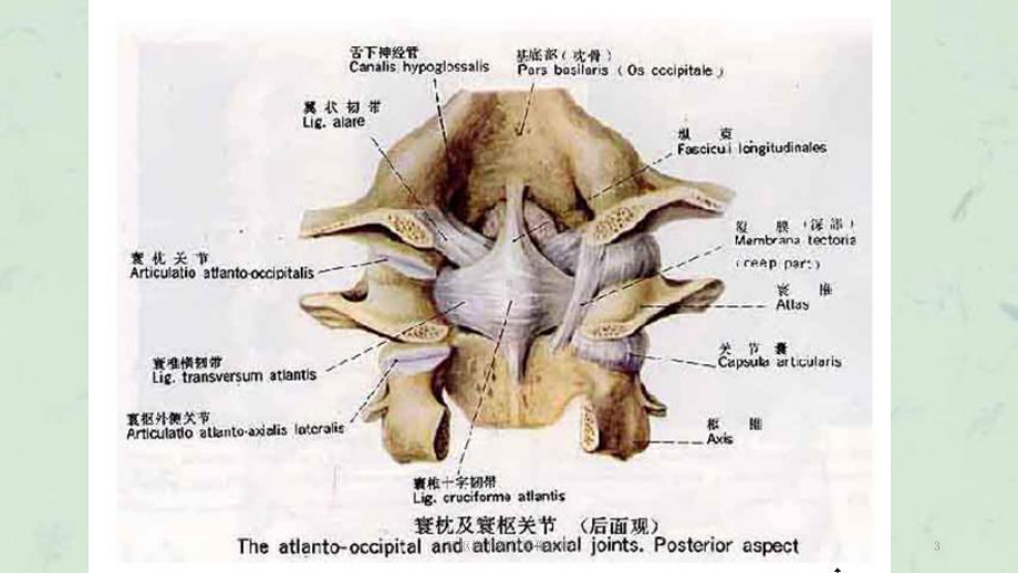 环枢椎半脱位影像诊断课件.ppt_第3页