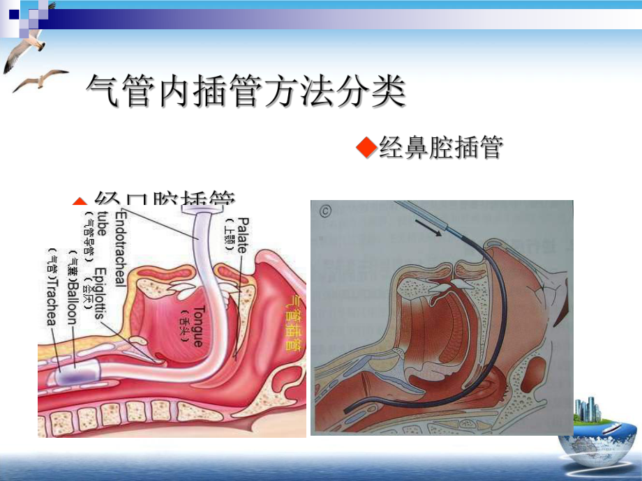 气管内插管术—外科学课件.pptx_第3页