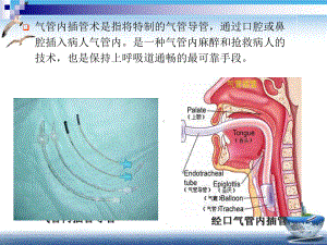 气管内插管术—外科学课件.pptx