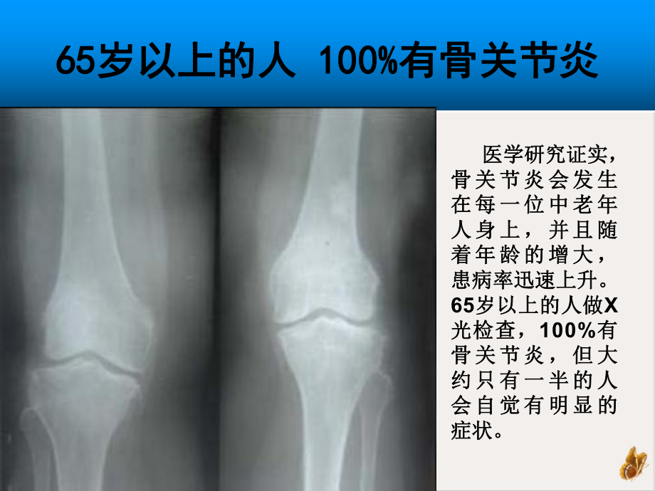 氨糖与骨关节病专家会销培训课件.ppt_第3页