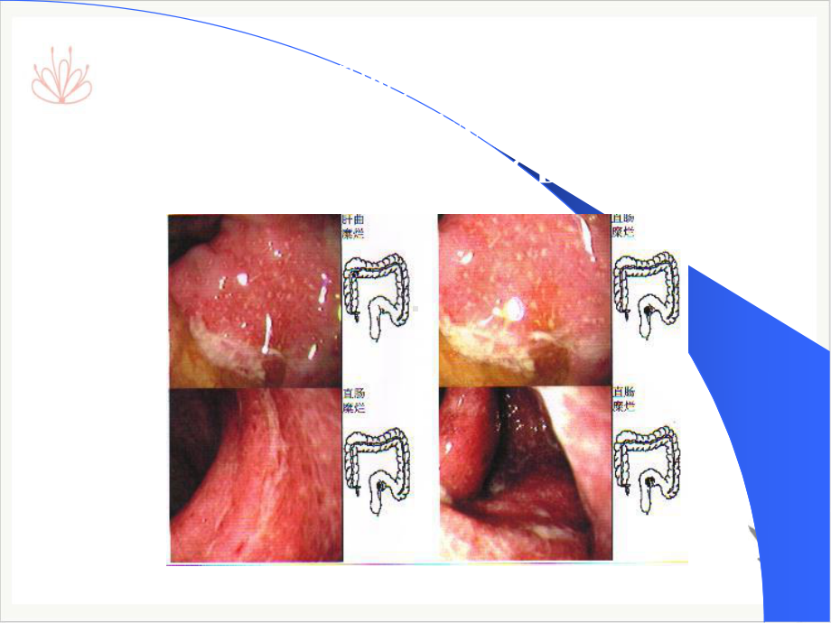 溃疡性结肠炎—大学课件(模板).pptx_第1页